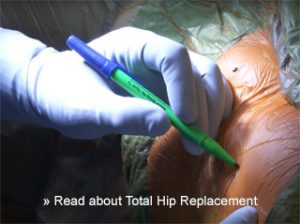total hip replacement article