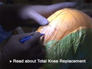 total knee replacement article