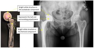 hip implant components
