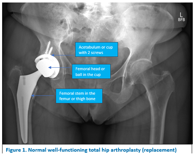 Parts and Materials for Hip Replacement