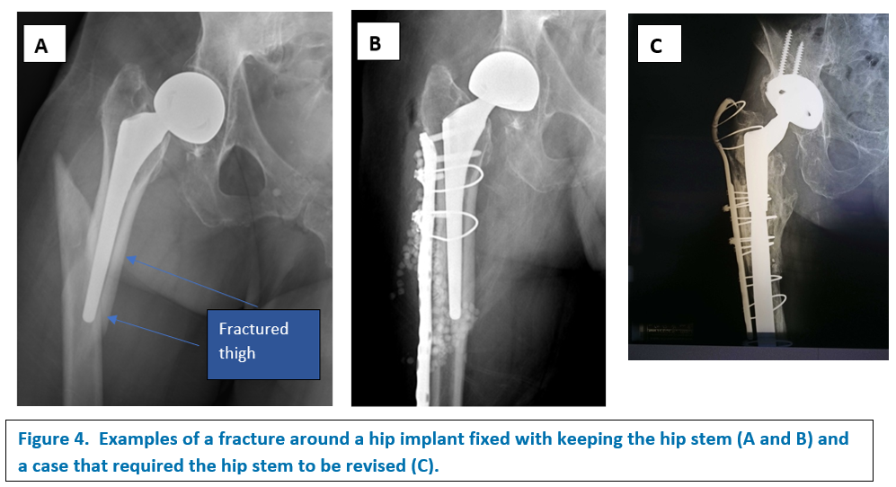 Revision Total Hip Arthroplasty Hip And Knee Care