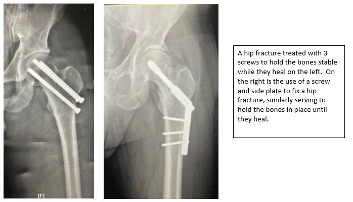 Replacement Surgery for Hip Fractures